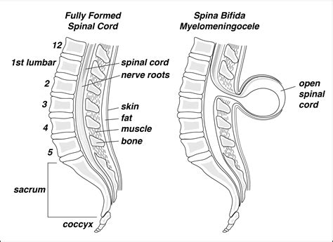 q05 - spina bifida